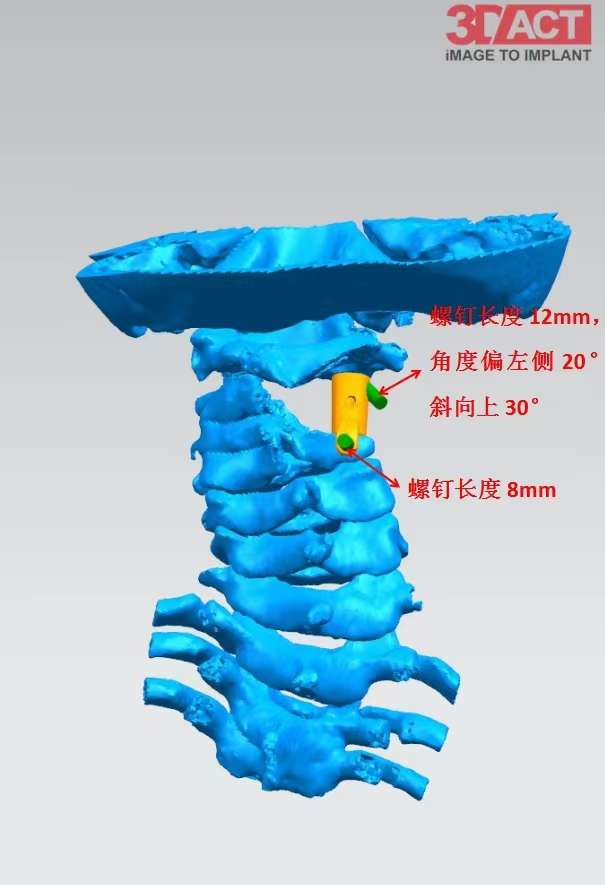 先进导航系统助儿童脊柱手术精准“百发百中”